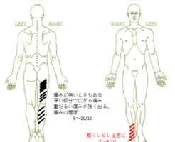 ギックリ腰のお客様。　帯広　整体　トレル