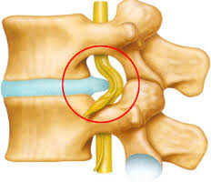 痛くもなんともない人の76%にヘルニアがみつかるってどー思います？