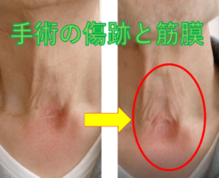 手術の傷跡と筋膜