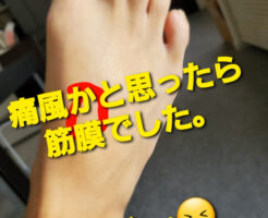 痛風かと思ったら筋膜でした。